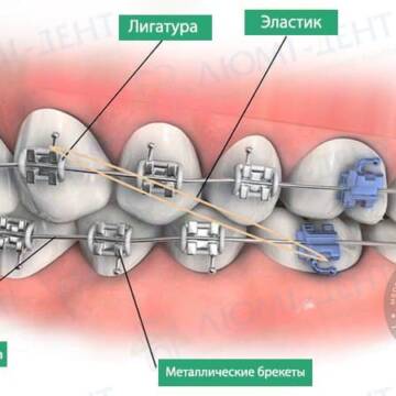Виправлення прикусу зубів брекетами