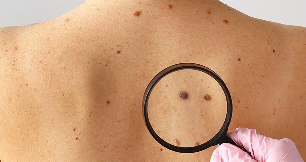 У Британії почали випробовувати на людях вакцину від раку шкіри