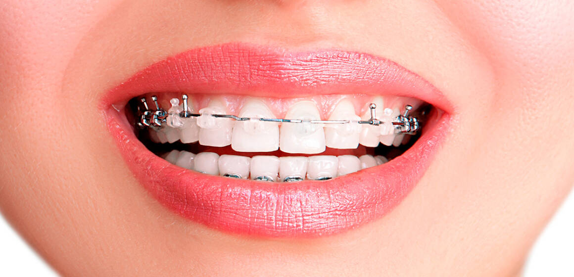 img__1 Ціна встановлення брекетів Вінниця: клініка Діадент