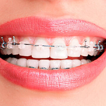 img__1 Ціна встановлення брекетів Вінниця: клініка Діадент