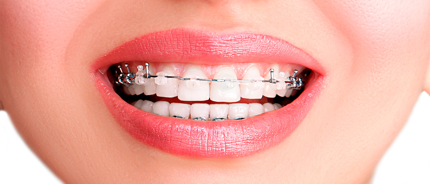 Ціна встановлення брекетів Вінниця: клініка Діадент