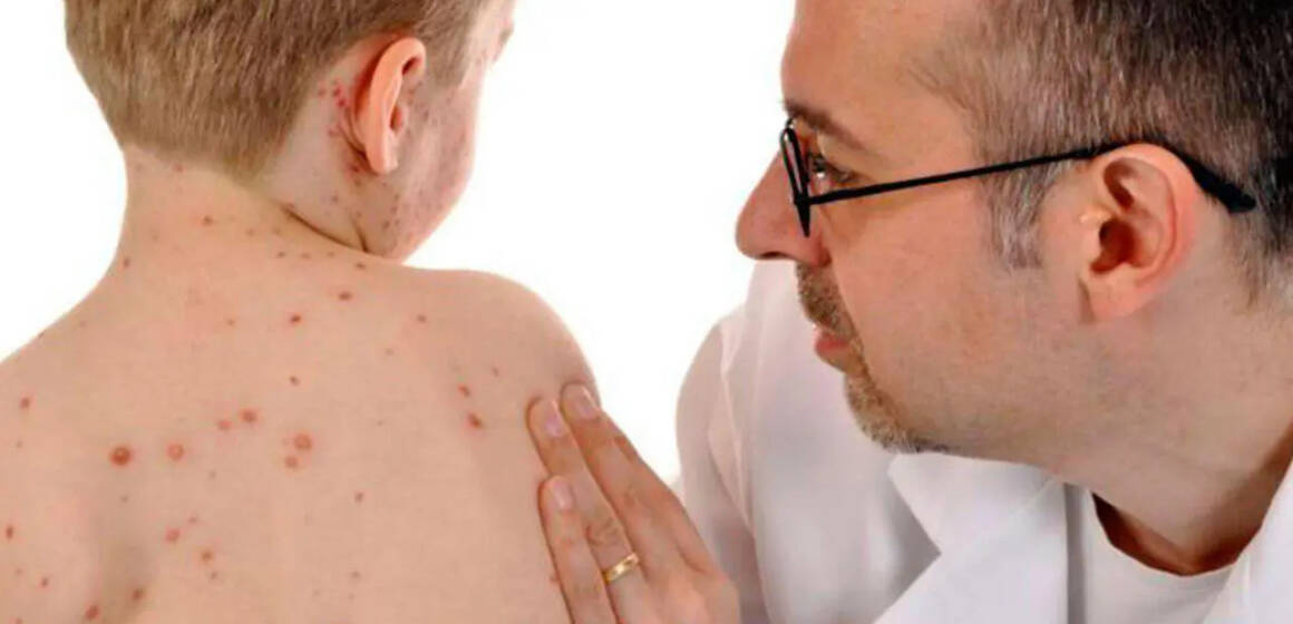 На Вінниччині зростає захворюваність на кір: чому важливо вакцинуватися?