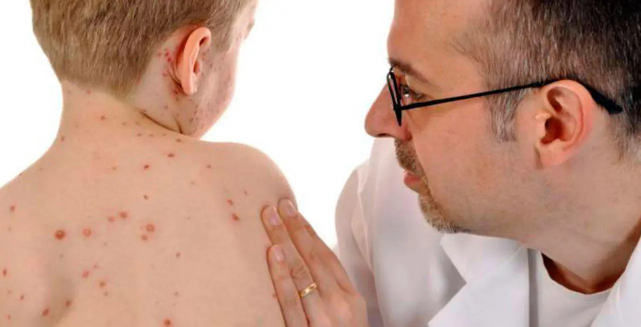 На Вінниччині зростає захворюваність на кір: чому важливо вакцинуватися?