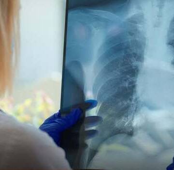 В Україні зростає кількість захворювань на позалегеневий туберкульоз