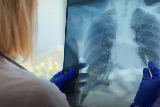 В Україні зростає кількість захворювань на позалегеневий туберкульоз