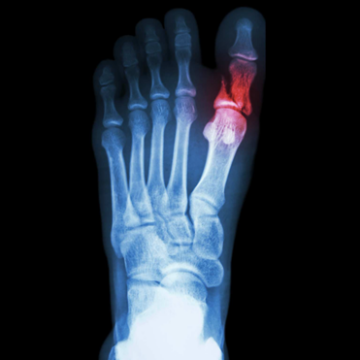 Перелом пальця на нозі: симптоми, діагностика та лікування