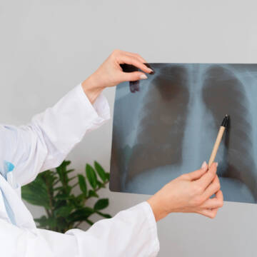 місто У січні на Вінниччині виявили нові випадки та рецидиви туберкульозу