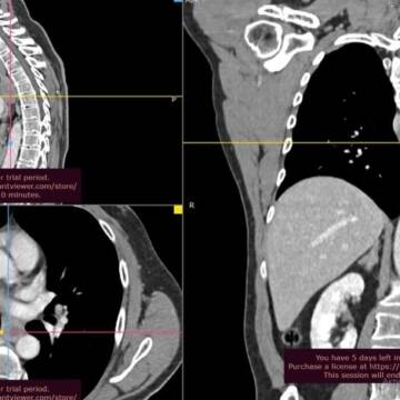 У Подільському онкоцентрі за тиждень прооперували три рідкісні випадки онкології грудної клітки