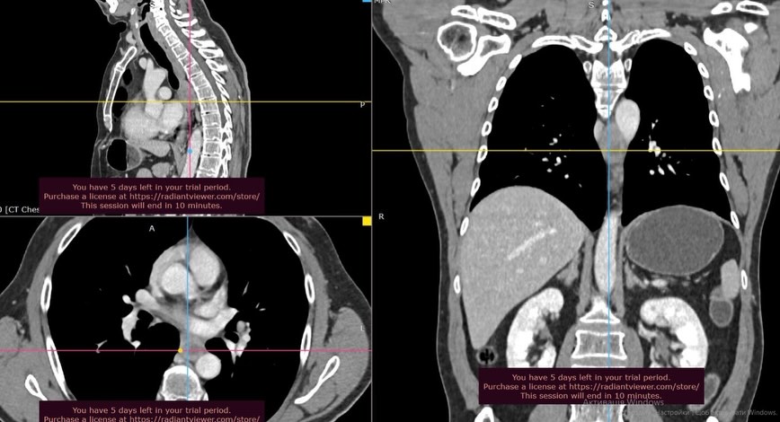 У Подільському онкоцентрі за тиждень прооперували три рідкісні випадки онкології грудної клітки
