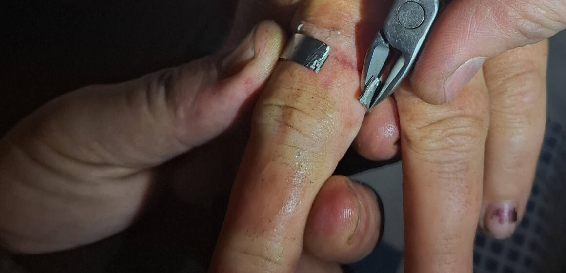 Металева «пастка»: на Вінниччині рятувальники визволяли палець жінки із шайби