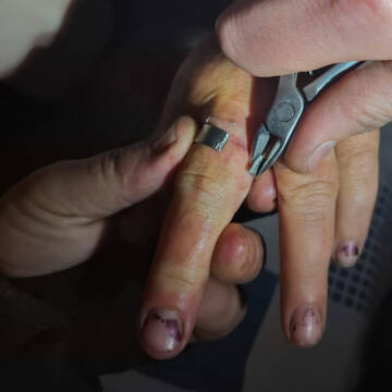 Металева «пастка»: на Вінниччині рятувальники визволяли палець жінки із шайби