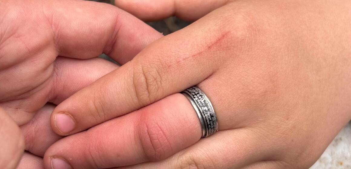 На Жмеринщині рятувальники визволили пальчик 10-річного хлопчика