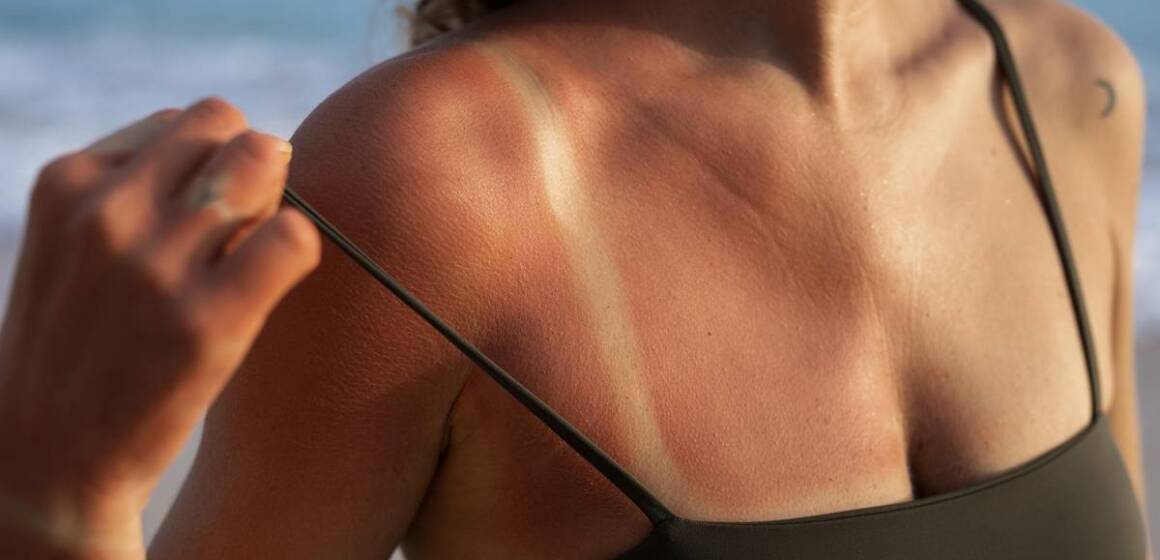 desktop_4UgL_details-woman-s-sunburn-skin-from-beach-sun Ультрафіолетова небезпека: як захистити шкіру, очі та здоров’я