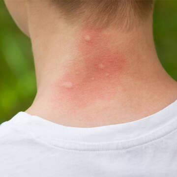 stinging-insect-bites-pic-01.m4ukaq Перша допомога при укусах комах: поради медиків